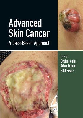 Advanced Skin Cancer: A Case-Based Approach 1st Edition - 9780367134716