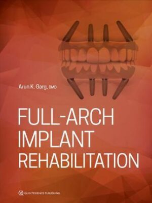 Full-Arch Implant Rehabilitation - 9780867158090